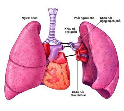 
Ghép phổi là một phương pháp điều trị bệnh phổi kẽ
