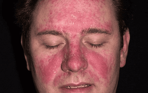 Having psoriasis on the face, what to do?