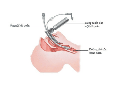 Kỹ thuật đặt nội khí quản đường miệng trong gây mê nội khí quản nội soi điều trị vô sinh