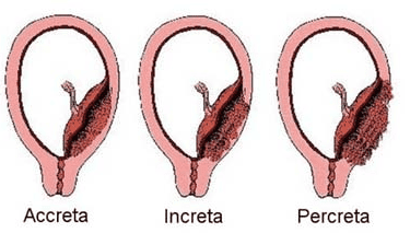 Endotracheal anesthesia for cesarean section on patients with comb teeth