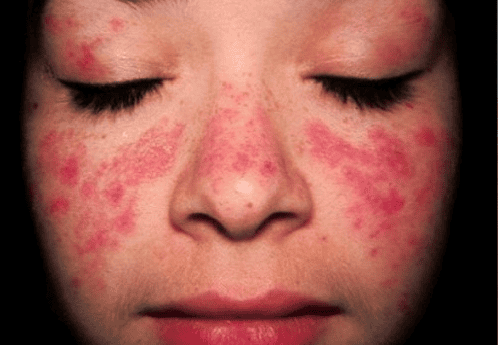 
Lupus cũng có thể ảnh hưởng đến niêm mạc da bên trong miệng và mũi của người bệnh
