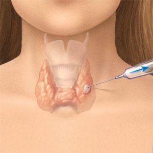 What is fine needle aspiration cytology for?