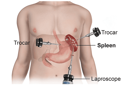 Background digitized splenic angiography procedure