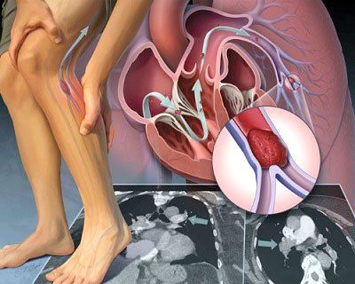 The dangers of arterial plaque and clogged arteries