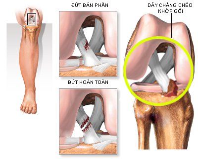 
Đứt dây chằng là một dạng tổn thương dây chằng khớp gối
