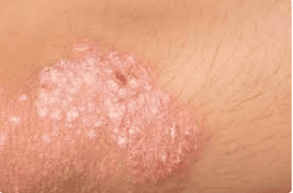 Pictures of plaque psoriasis