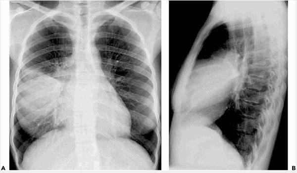 Phổi Đông Đặc: Nguyên Nhân, Triệu Chứng và Cách Điều Trị Hiệu Quả