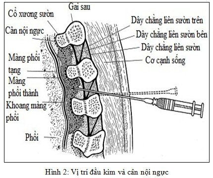 What is edge spinal anesthesia?