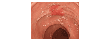 
Một polyp ở đại tràng xuống, có đặc điểm các niêm niêm mạc hội tụ về phía polyp, kết quả giải phẫu bệnh là ung thư xâm lấn lớp dưới niêm mạc
