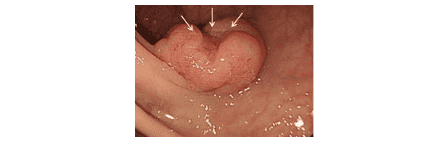 
Polyp có loét bề mặt – hãy cẩn thận với nguy cơ ung thư xâm lần ở dạng polyp này.
