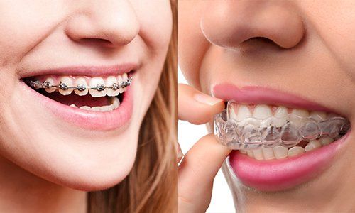 Braces hurt? Which stage is the most painful?