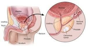 Những điều cần biết nếu bạn mắc ung thư tuyến tiền liệt (prostate cancer) - Phần 2