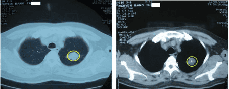 Applications of high-resolution lung computed tomography