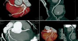 Significance of coronary computed tomography calcification score