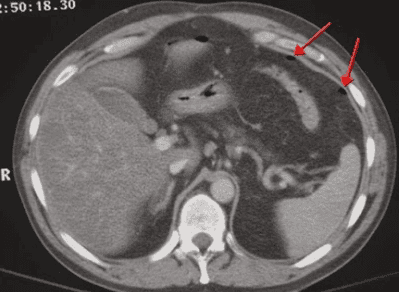 The procedure of computed tomography of the abdomen/subframe without contrast injection