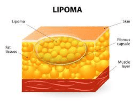 
Dưới hình ảnh X-quang, u mỡ Lipoma có mật độ khối đậm độ mỡ đồng nhất, đường bờ giới hạn rõ và không bắt thuốc sau khi tiêm.
