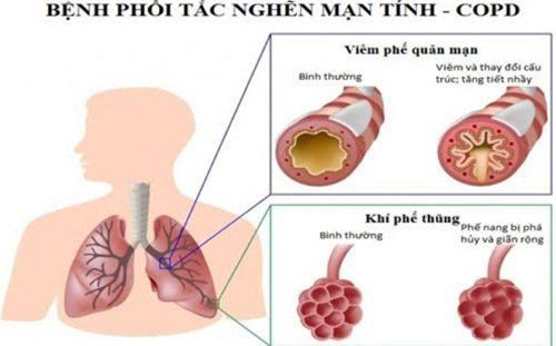 
Bệnh nhân bị viêm phổi tắc nghẽn mạn tính khi gây mê toàn thân bằng đặt nội khí quản có nguy cơ cao dẫn đến cơn co thắt thanh – khí - phế quản
