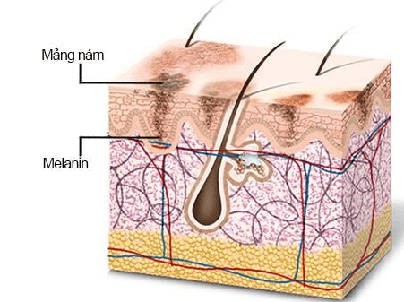 Melanin protects us from skin cancer but can also cause it