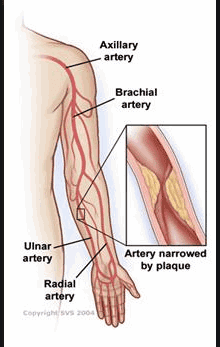 Procedure for CT angiography of upper extremities