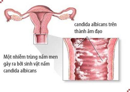 
Nếu bạn dùng thuốc Acticlate trong thời gian dài có thể bị nhiễm trùng nấm âm đạo
