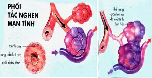 Thiếu oxy máu do bệnh phổi tắc nghẽn mãn tính