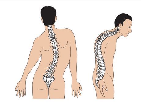 
Vẹo cột sống tự phát xảy ra trong độ tuổi từ 10 đến 18
