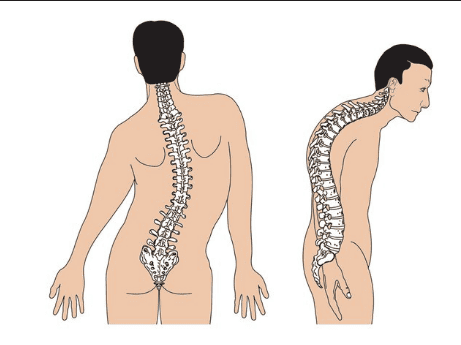 Endotracheal anesthesia for kyphosis correction surgery