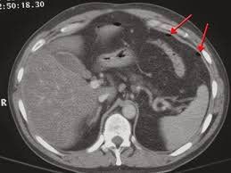 Computed tomography (CT) of the liver with biliary reconstruction