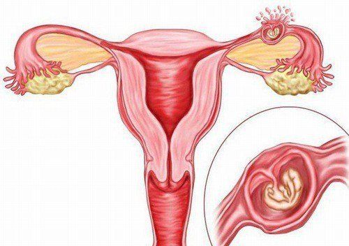 2 lần thai ngoài tử cung, thuốc vòi trứng trái Cotte dương tính khu trú, vòi trứng phải một đoạn âm tính liệu có mang thai được nữa không?