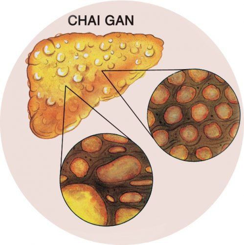 
Bệnh chai gan biểu hiện như thế nào?
