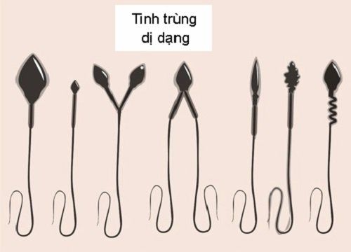 Dị dạng về hình thể tinh trùng điều trị như thế nào?