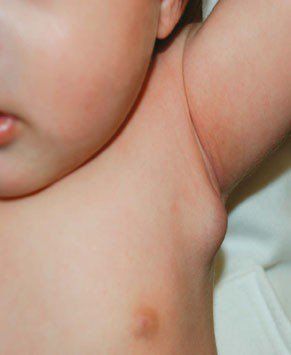 Trẻ sơ sinh nổi hạch nách không đau, không sưng tấy là dấu hiệu bệnh gì?