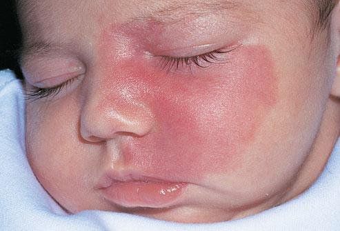 Bớt đỏ trên mặt có ảnh hưởng đến sức khỏe của trẻ không?