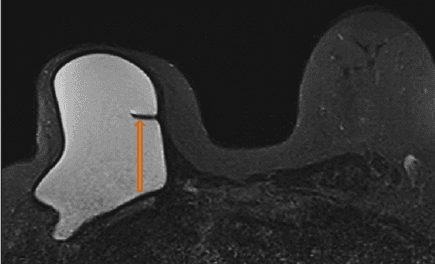 
Hình 4: MRI vú đánh giá túi ngực, không dùng thuốc đối quang từ.
