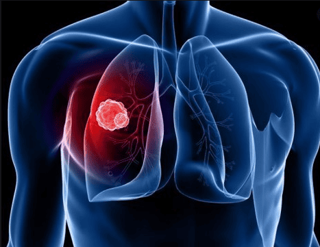 Lung protection during anesthesia