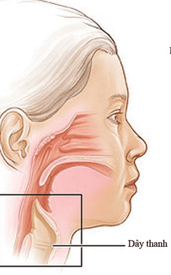 
Liệt dây thanh quản ảnh hưởng tới khả năng phát âm và đường thở
