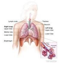 Endoscopic tracheobronchial stent placement