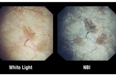 
Kỹ thuật nội soi dải ánh sáng hẹp (Narrow Band Imaging) nhằm nội soi phế quản chẩn đoán
