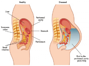 
Nhìn hình thái bụng, bác sĩ có thể đánh giá được tình trạng cổ trướng ở người bệnh
