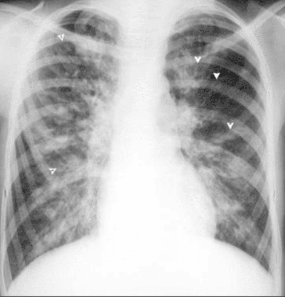 Bronchiectasis on x-ray | Vinmec