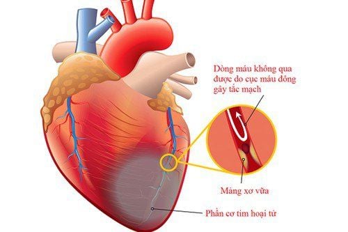 Cardiovascular rehabilitation for patients after myocardial infarction