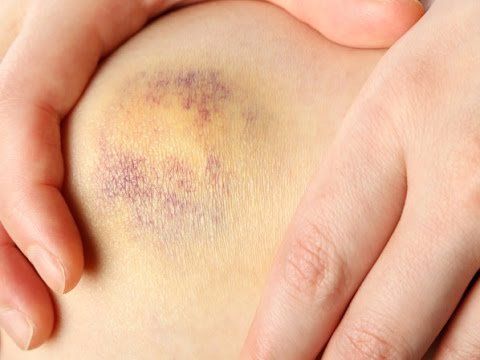 Is thrombocytopenic purpura an autoimmune disease?