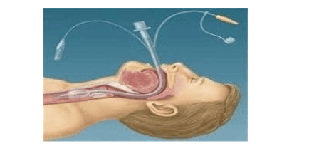 
Đặt nội khí quản cho bệnh nhân
