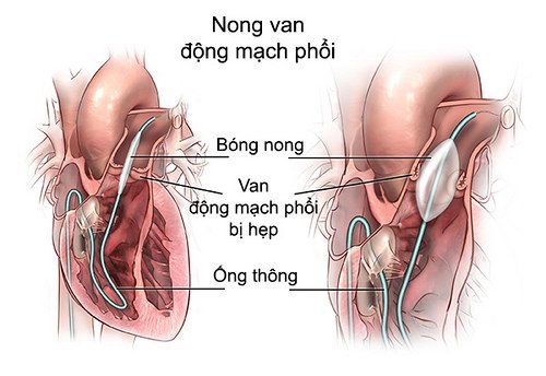 Chỉ định nong hẹp nhánh động mạch phổi