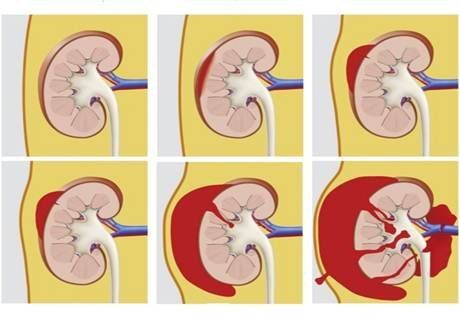 Closed kidney injury: What you need to know