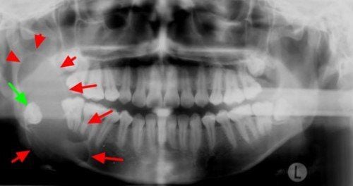 Treatment of dental cysts