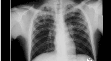 Chest X-ray methods and what you need to know