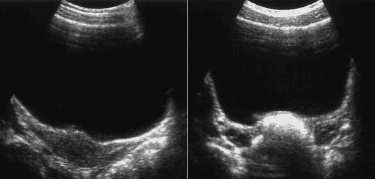 What does DAP 30mm uterine ultrasound and 7mm clear endometriosis mean and are you pregnant?