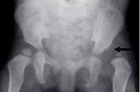 Congenital hip dislocation: What you need to know