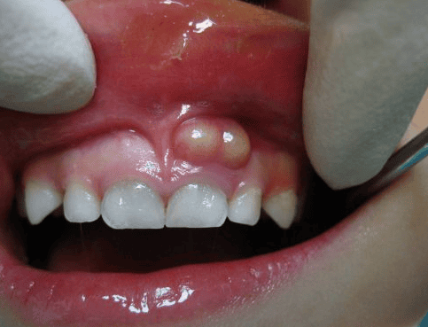 
Abscess ở vùng cuống răng
